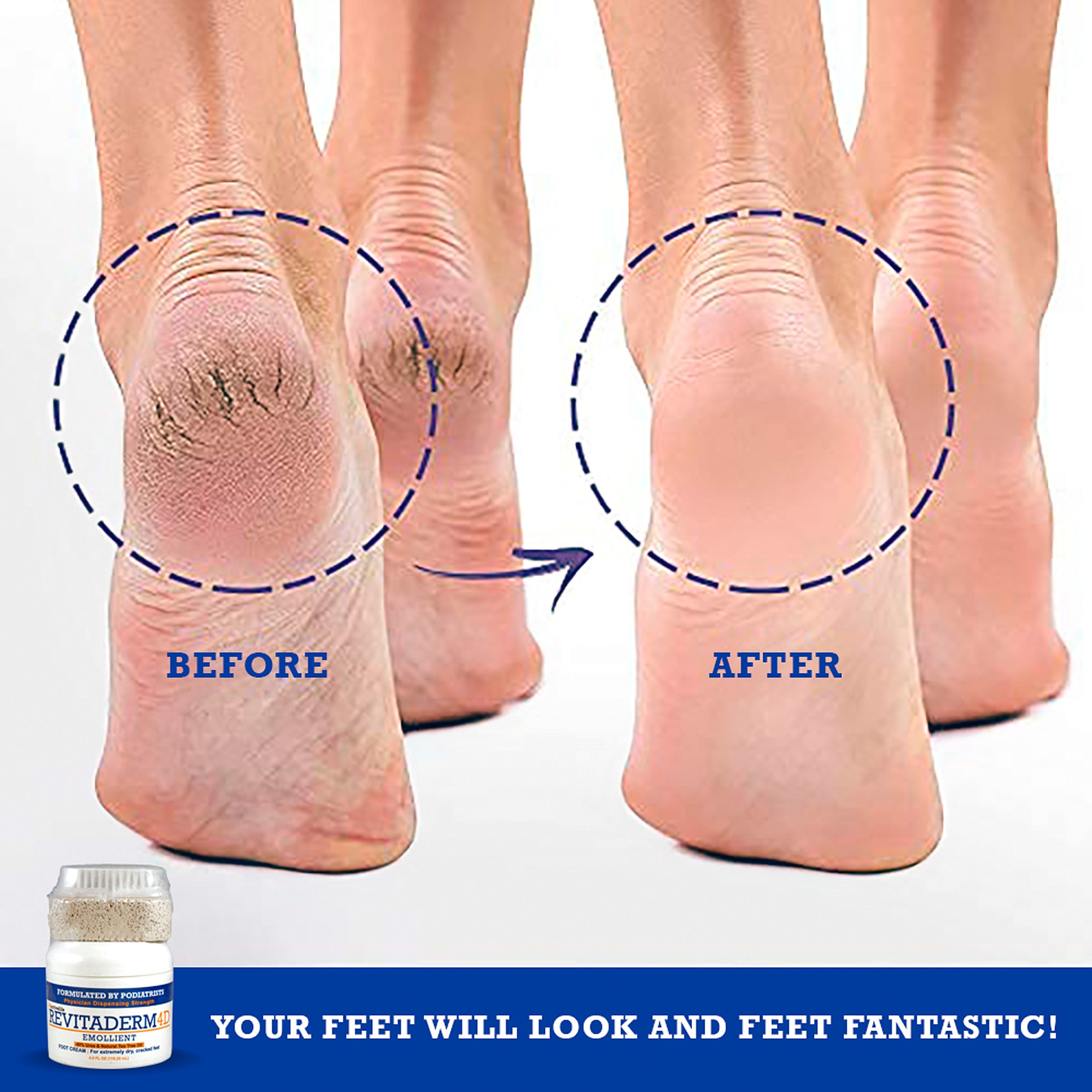 Cracked Heels | Elim Spa Products